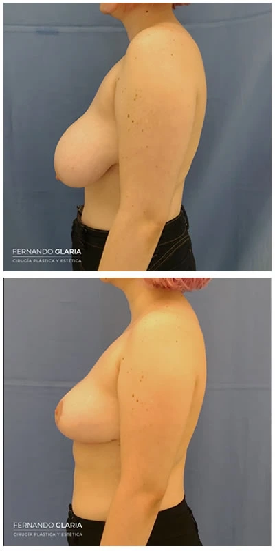 cirugia de reduccion mamaria