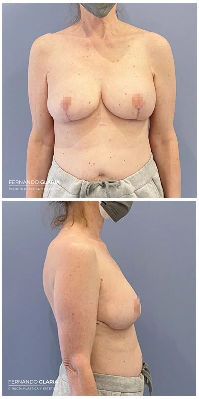 revision y remplazo de protesis mamaria